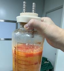 宜宾水动力吸脂手术要做多久？